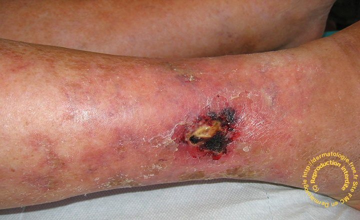 Angiodermite nécrotique (atteinte de la microcirculation)