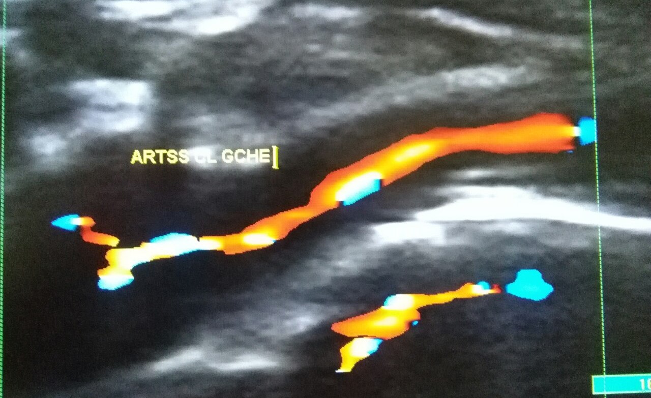Echo-doppler des artères et des veines des membres supérieurs
