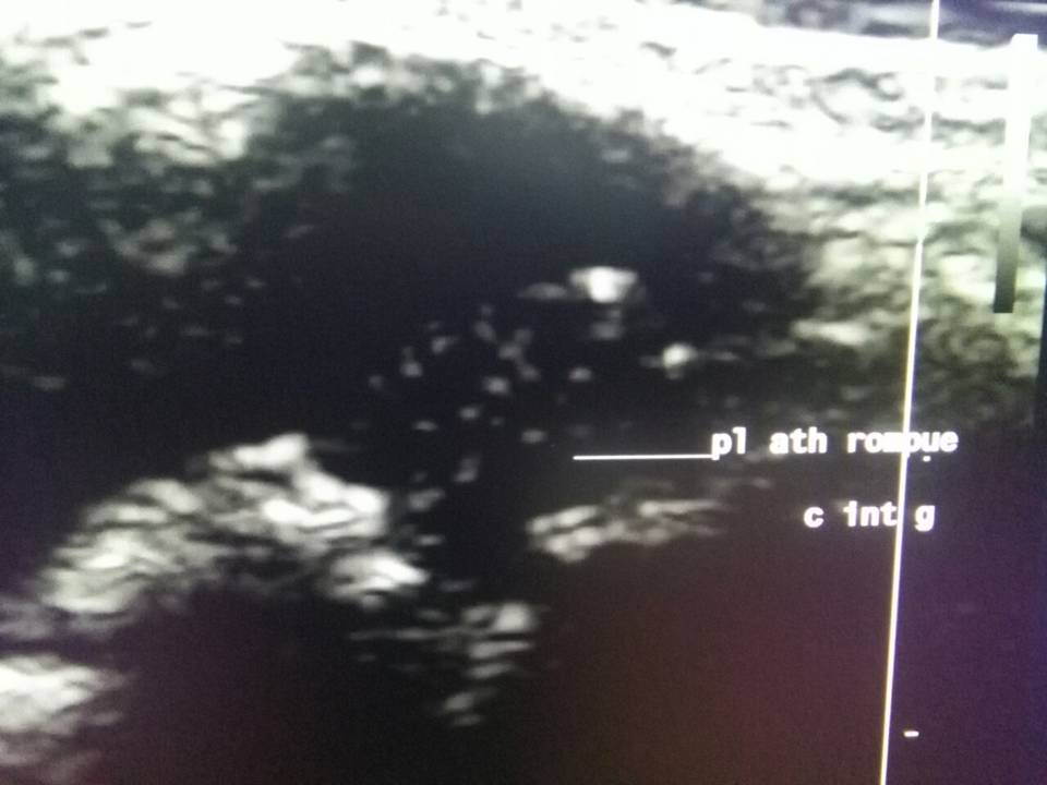 Echo-doppler des troncs supra aortiques