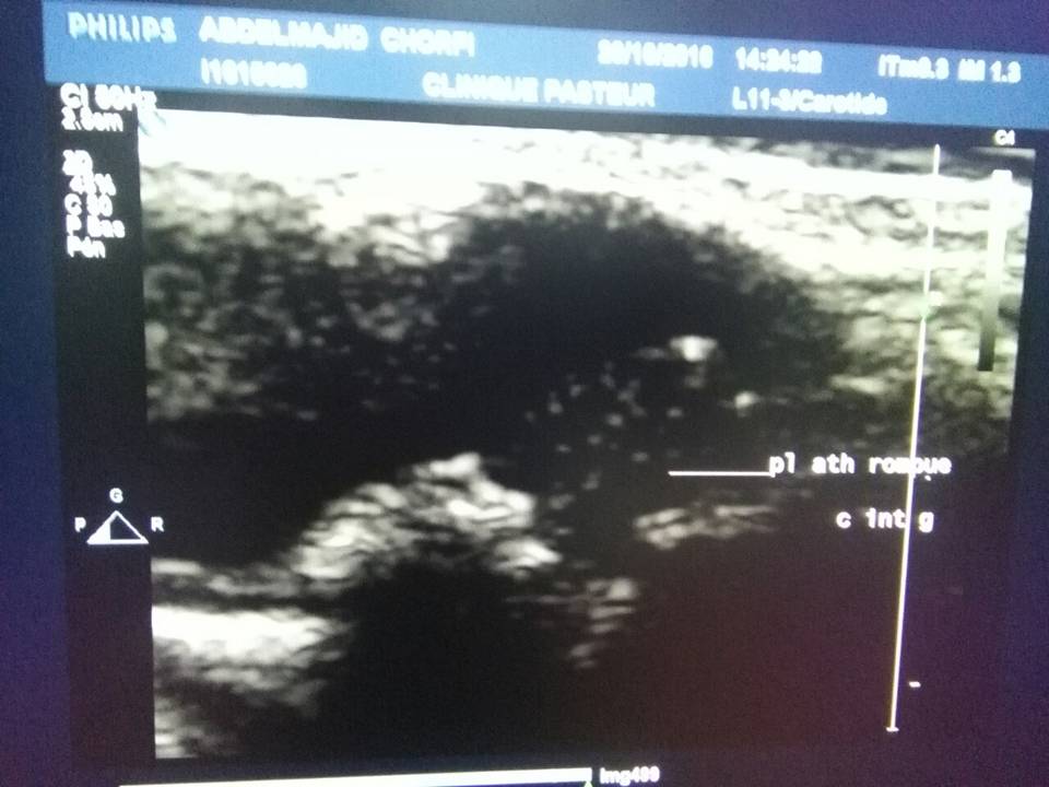 Echo-doppler des troncs supra aortiques