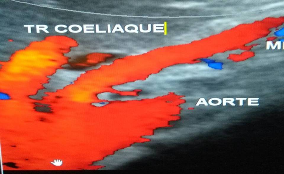 Echo-doppler des artères digestives