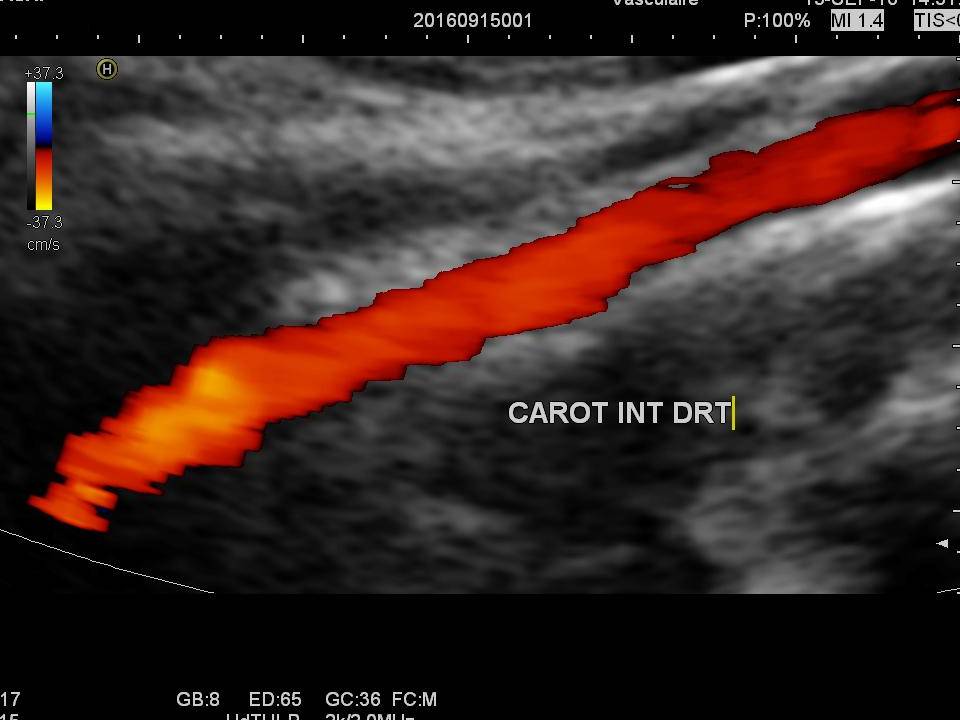 Echo-doppler des troncs supra aortiques