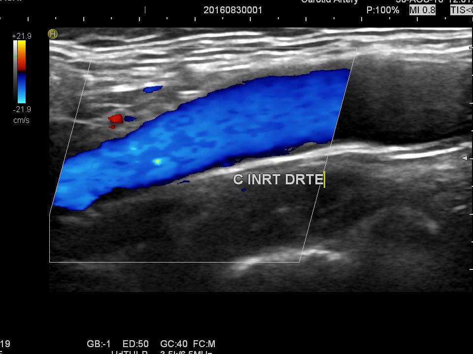 Echo-doppler des troncs supra aortiques
