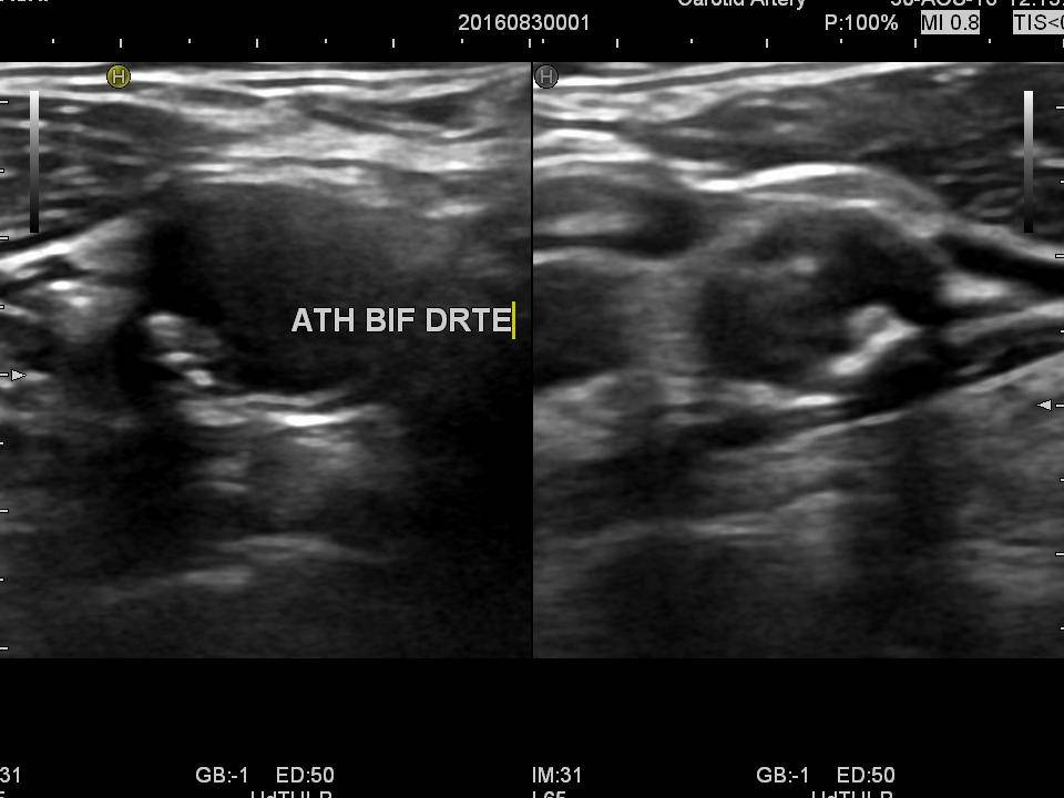 Echo-doppler des troncs supra aortiques