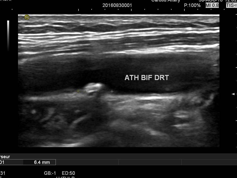 Echo-doppler des troncs supra aortiques