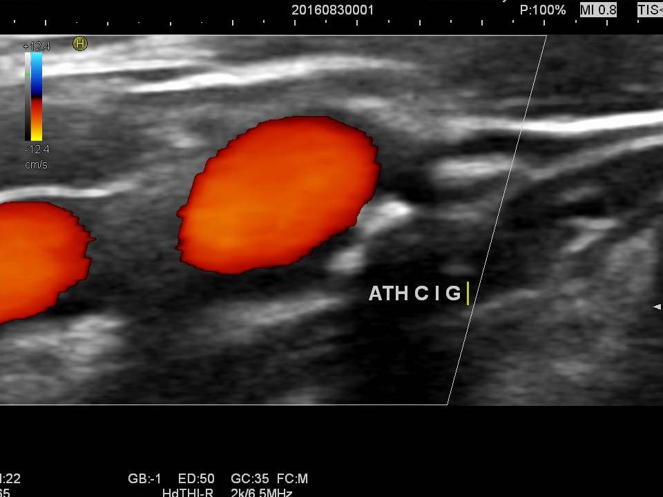 Echo-doppler des troncs supra aortiques