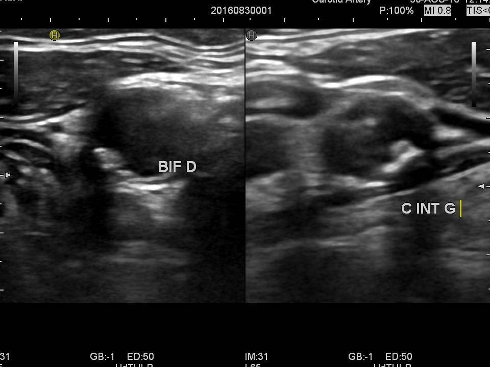 Echo-doppler des troncs supra aortiques