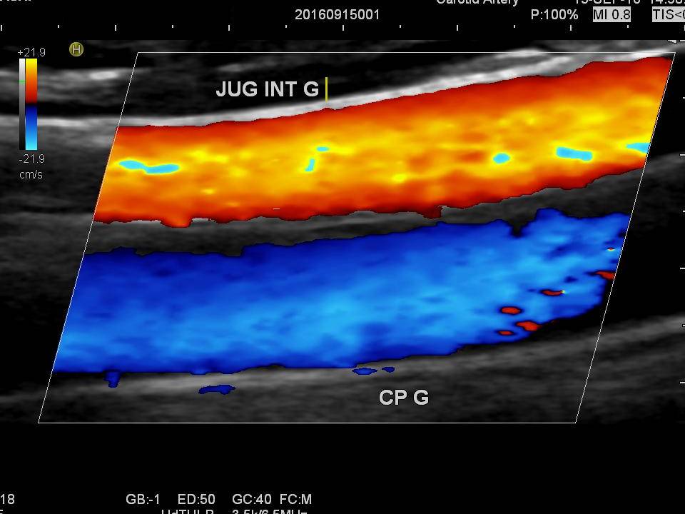 Echo-doppler des troncs supra aortiques