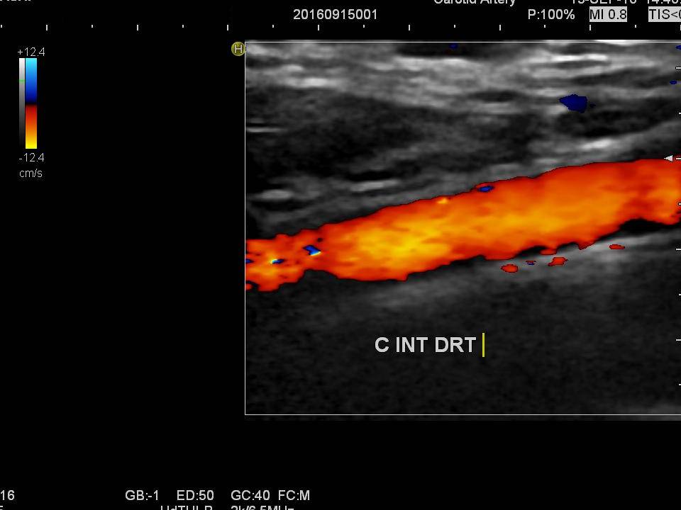 Echo-doppler des troncs supra aortiques