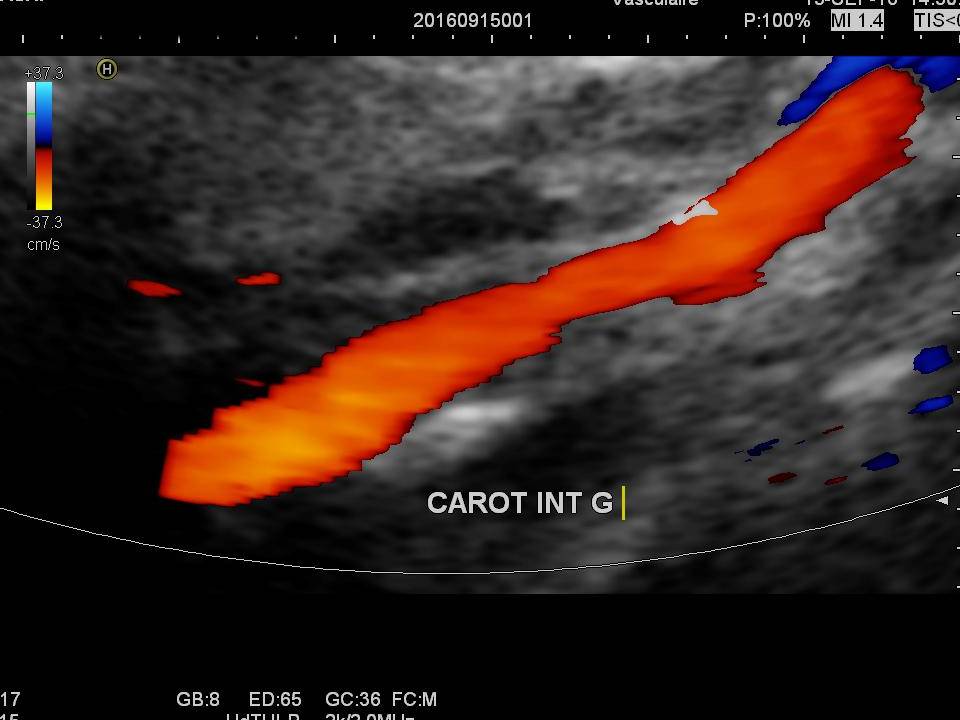 Echo-doppler des troncs supra aortiques