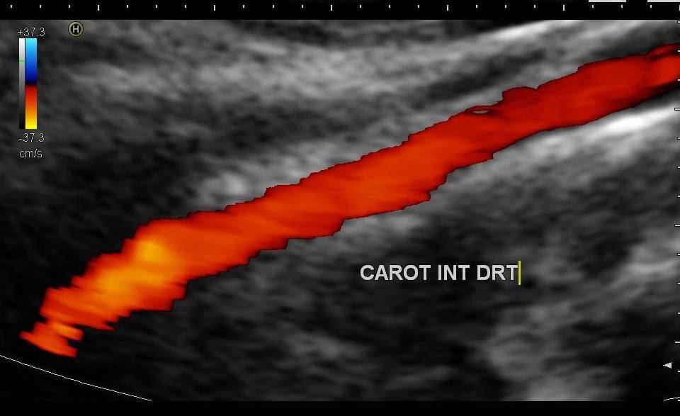 Echo-doppler des troncs supra aortiques