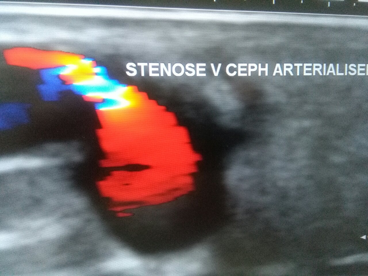 Echo-doppler des fistules artério-veineuses