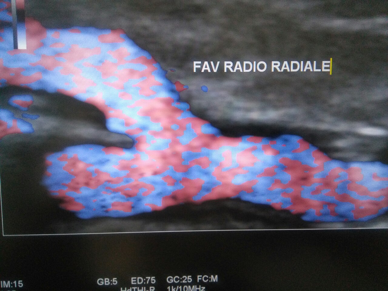 Echo-doppler des fistules artério-veineuses