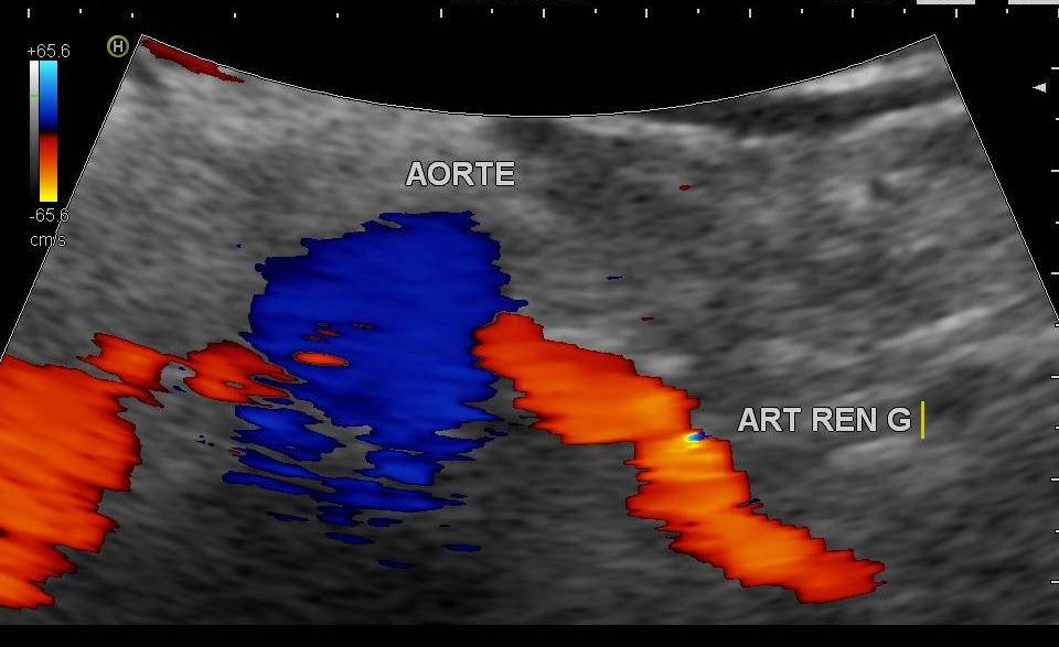 Echo-doppler des artères rénales