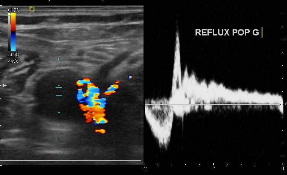 Echo-Doppler Veineux Membre inferieur