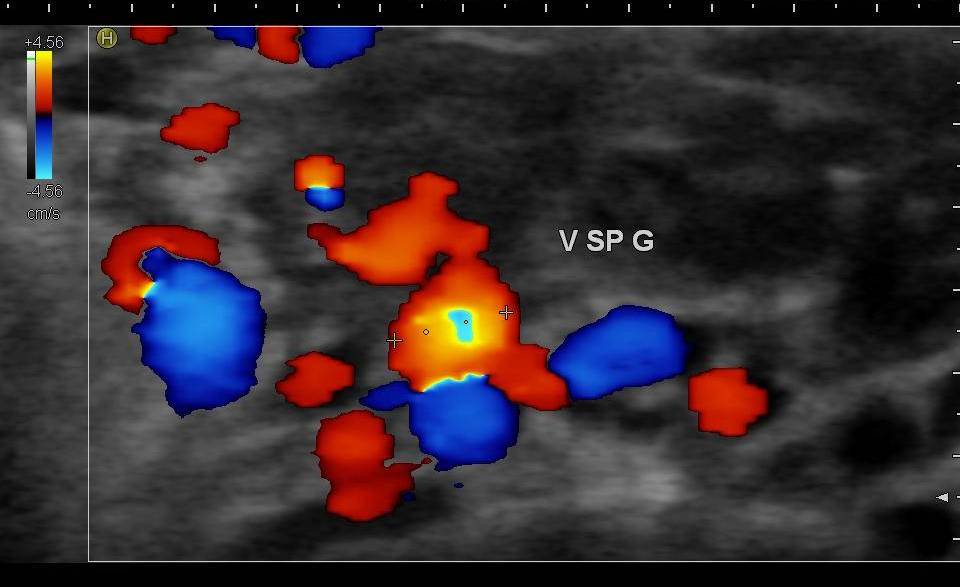 Echo doppler testiculaire