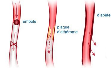 Les ulcères de jambes d'origine artérielle