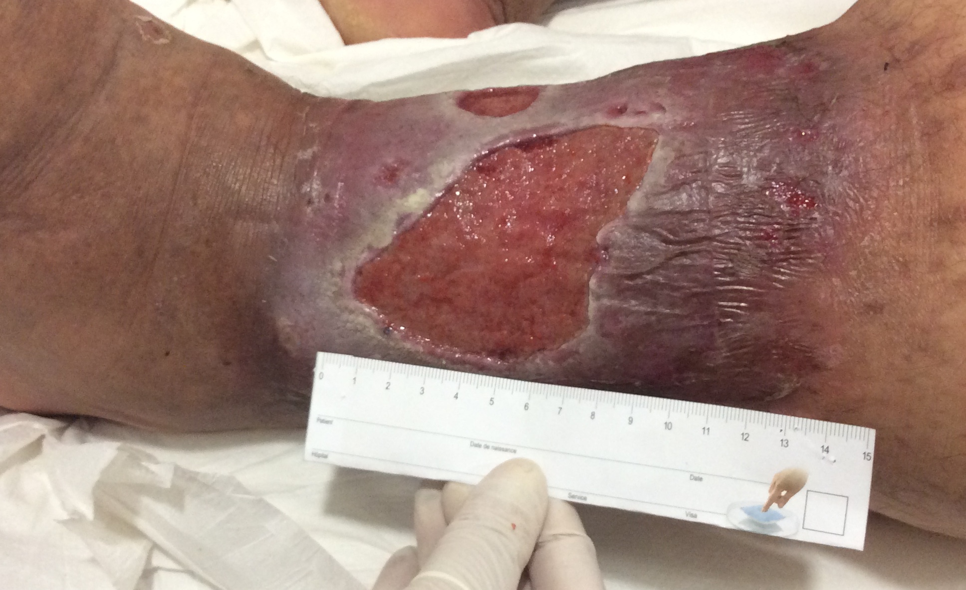 Les ulcères de jambes d'origine veineuse (les plus fréquents)
